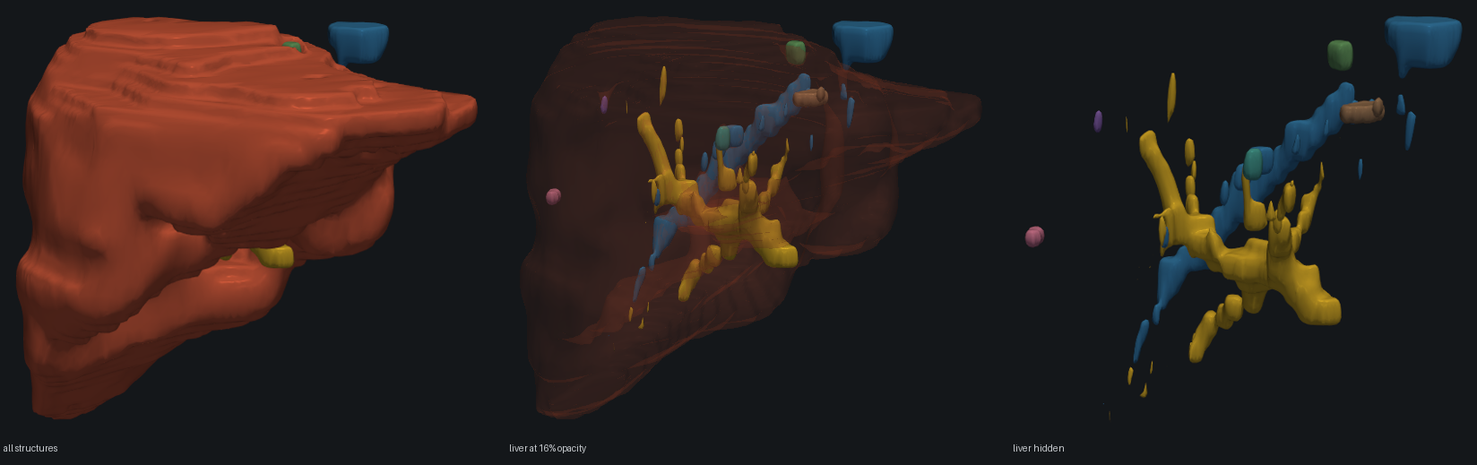 A liver shown solid, then at 16 percent opacity revealing branching vessel trees and metastases inside it, then with the liver hidden entirely